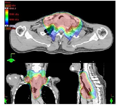 頚部食道IMRTの図4